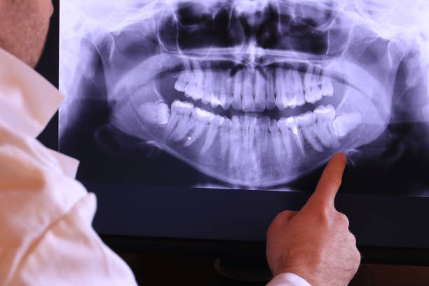 Best Emergency Treatment for Dental Infections or Abscesses in Golden Beach, MD