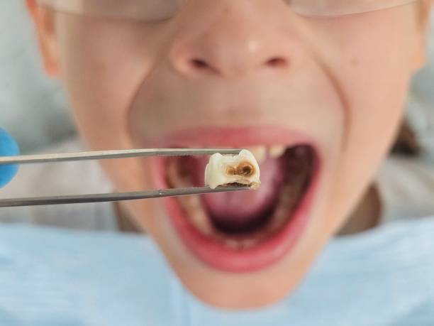 Best Emergency Root Canal Treatment in Golden Beach, MD